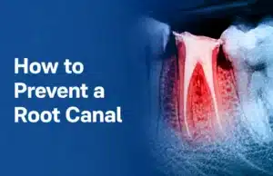 how to prevent a root canal